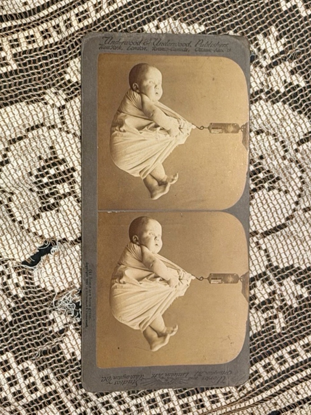 Vintage Stereograph Antique Underwood & Underwood Stereoview Medical baby